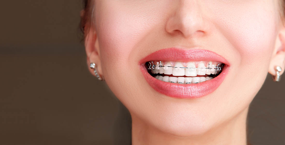 Çapraşık Dişlerin Düzeltilmesi (Ortodonti)