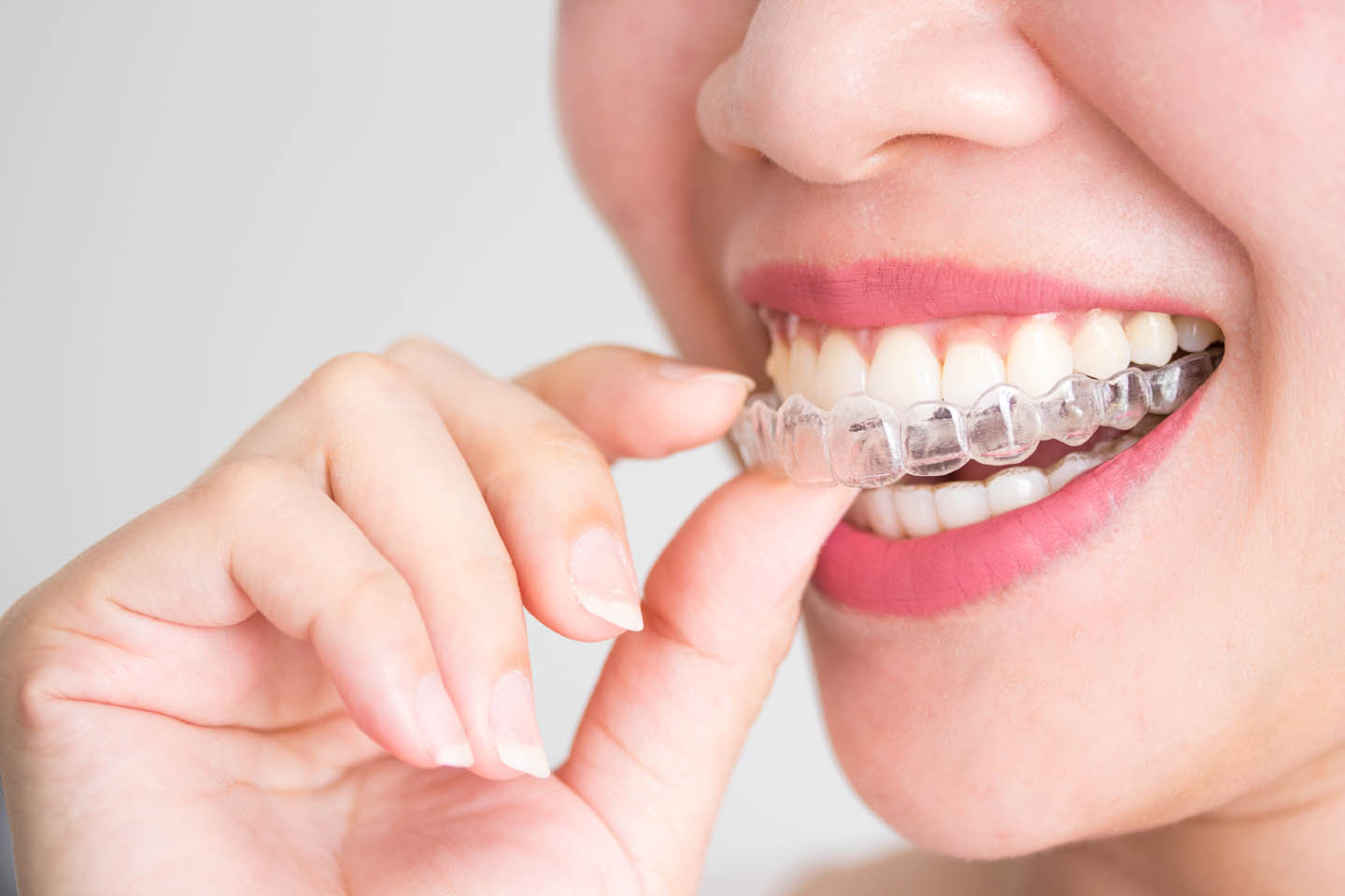 Correction of Crowded Teeth (Orthodontics)
