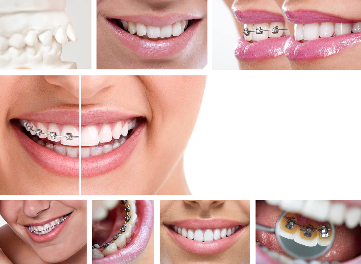 Ortodontik Tedavi Nasıl Olur?